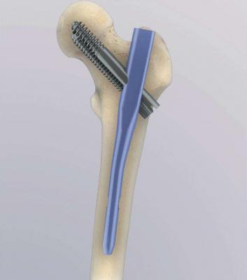 金屬髓內釘系統(tǒng)