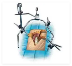 sxy-fq型腹部手術(shù)牽開(kāi)器代理